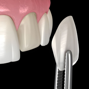 Porcelain Veneers