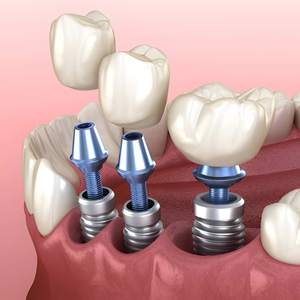 Zirconium Crowns